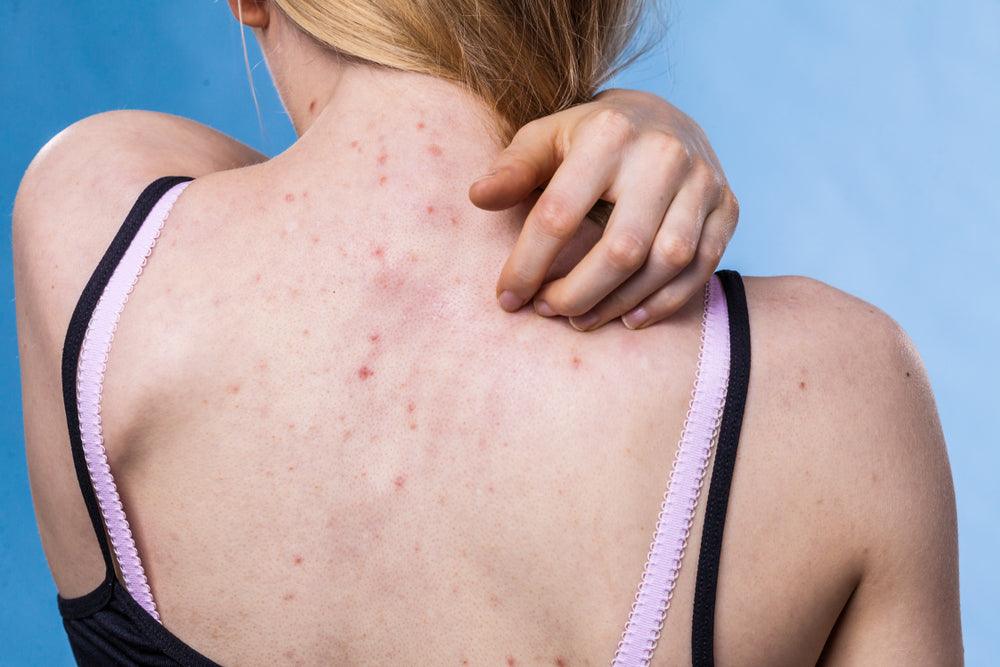 Here's Why Back and Chest Acne is So Common & How to Treat It