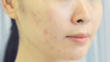 Damaged facial skin with redness, breakouts and blemishes