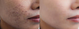 Image before and after dark spot scar acne and melasma pigmentation skin facial treatment on face asian woman