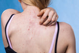  Young woman showing her back with acne, red spots